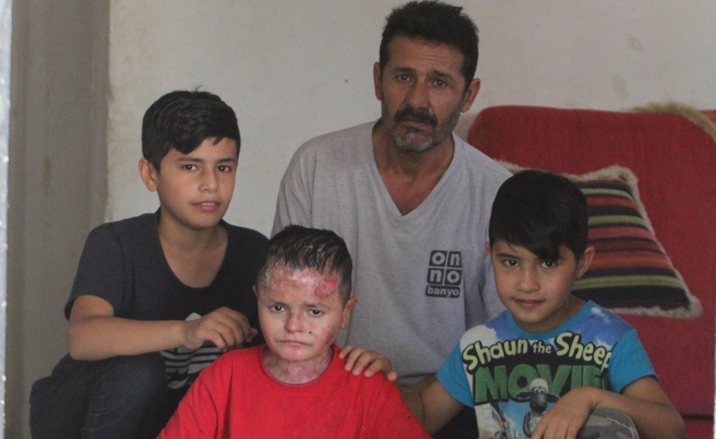 Suriyeli 'kelebek' hastası Aladdin'in Türkiye aşkı